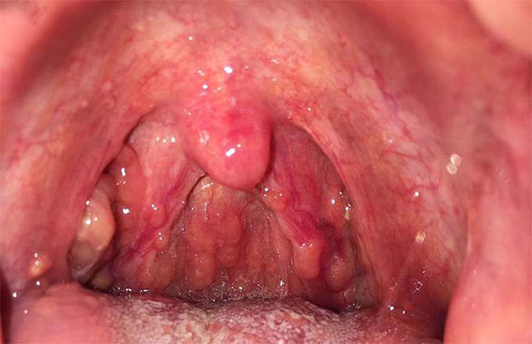 Viêm họng hạt (viêm họng quá phát) là thể lâm sàng của viêm họng mãn tính