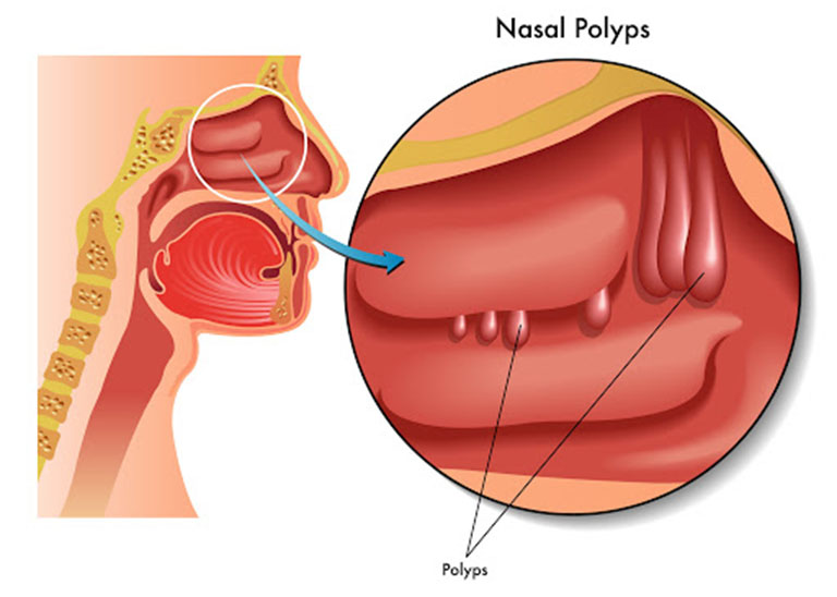 Polyp mũi, lệch vách ngăn mũi,... là nguyên nhân dẫn đến viêm họng hạt và các thể viêm họng mãn tính khác