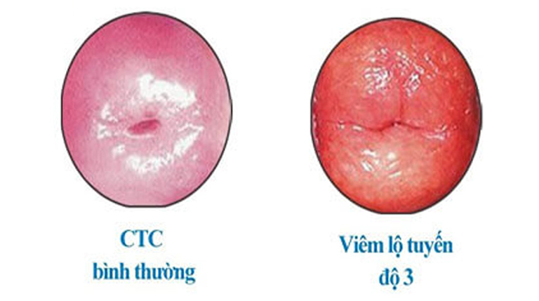 Viêm lộ tuyến độ 3 là tình trạng viêm nhiễm đã chiếm gần hết hoặc toàn bộ phần cổ tử cung