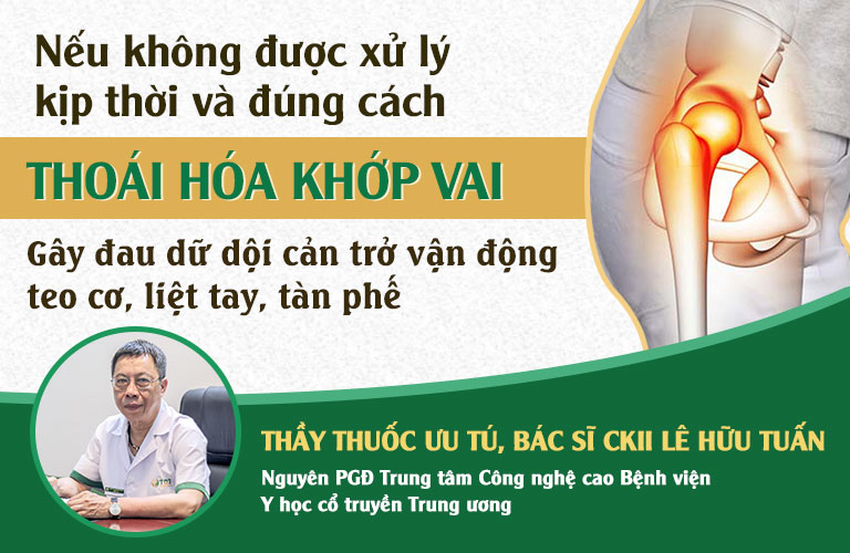 Bác sĩ Lê Hữu Tuấn cảnh báo mức độ nguy hiểm của thoái hóa khớp vai