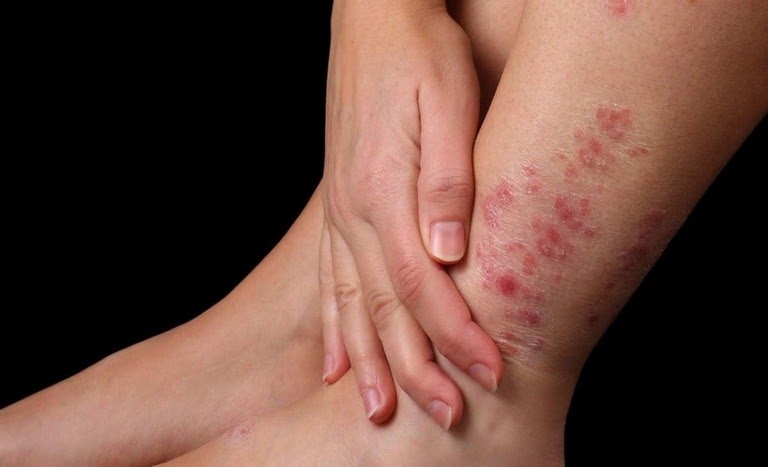 Vùng da bị tổn thương do vảy nến có nguy cơ lan rộng sau mỗi đợt tái phát