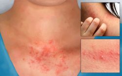 Viêm da tiếp xúc xảy ra khi da tiếp xúc với chất gây dị ứng da chẳng hạn như hóa chất hoặc các loại thực vật độc