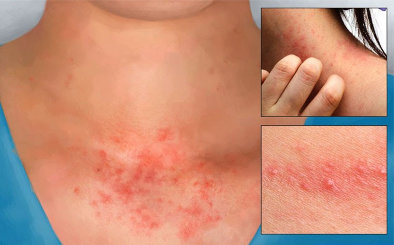 Viêm da tiếp xúc xảy ra khi da tiếp xúc với chất gây dị ứng da chẳng hạn như hóa chất hoặc các loại thực vật độc