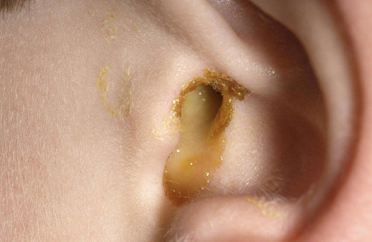 Viêm họng hạt có biến chứng thành viêm tai giữa