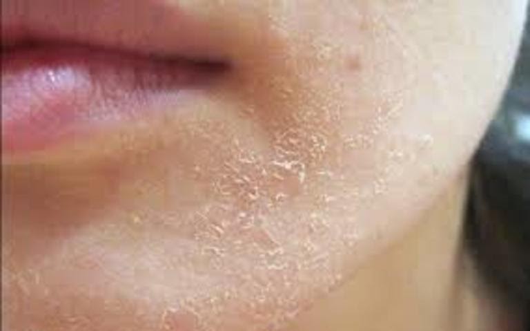 Da khô và bong tróc là triệu chứng dị ứng với không khí lạnh dễ nhận biết