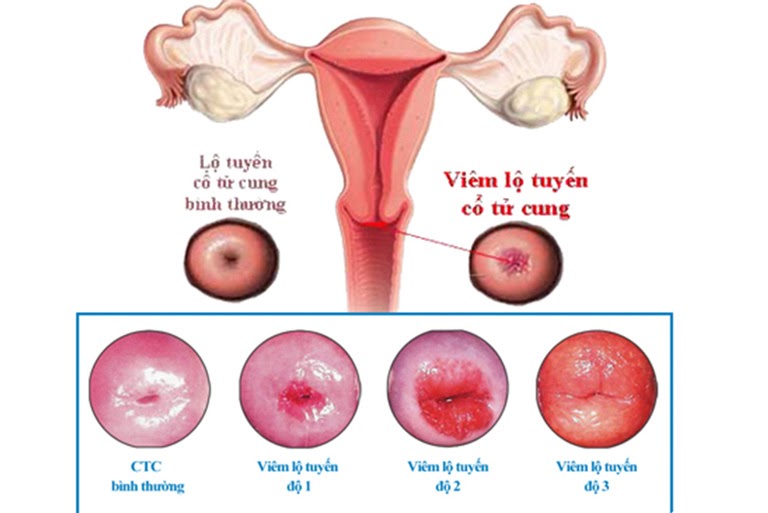 Hình ảnh cổ tử cung bình thường và khi cổ tử cung bị viêm nhiễm 