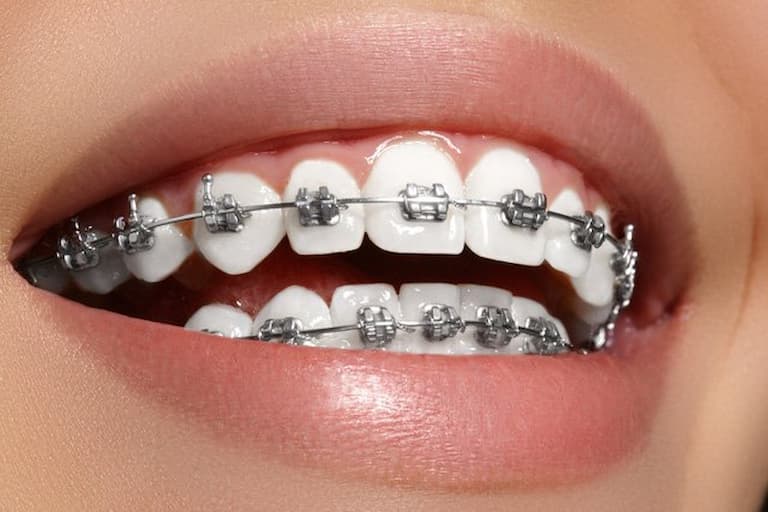 Niềng răng mắc cài kim loại là một trong những phương pháp phổ biến nhất hiện nay