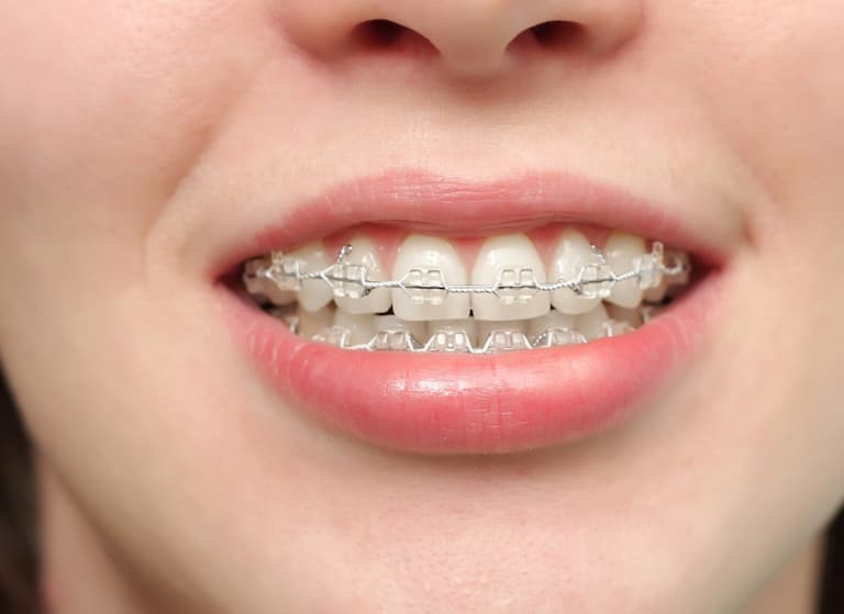 Niềng răng là gì? Quy trình, Chi phí và Lưu ý không thể bỏ qua - Xuất bản thông tin
