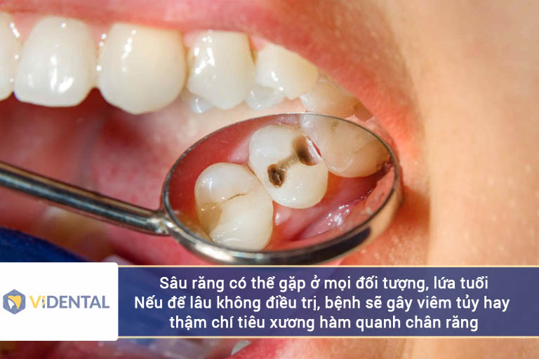 Sâu răng có thể xảy ra ở mọi đối tượng và lứa tuổi