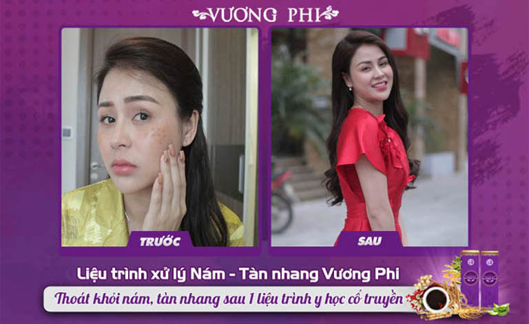 Làn da của diễn viên Thu Trang trước và sau khi dùng Vương Phi
