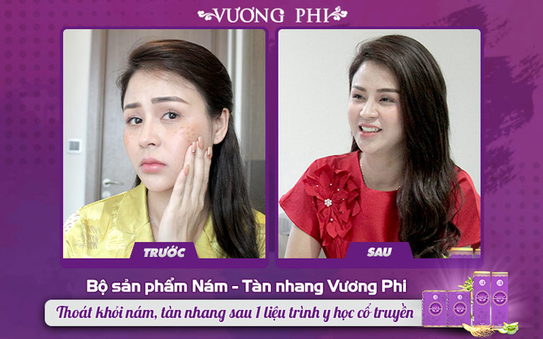 Chị Lương Thu Trang trước và sau khi sử dụng bộ sản phẩm Vương Phi