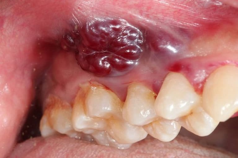 Nhổ răng khôn không đảm bảo có thể dẫn tới tình trạng nhiễm trùng răng