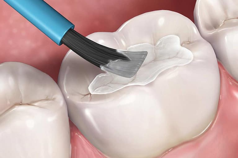 Trám răng là một trong những phương pháp được ưu tiên để điều trị sâu răng