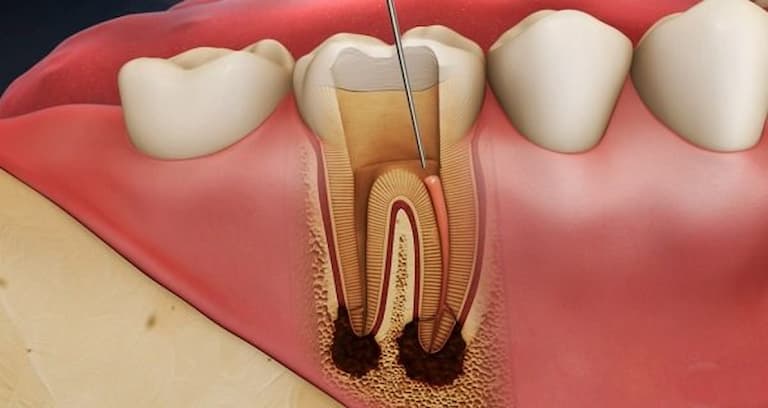 Sâu răng nặng do vi khuẩn tấn công sâu vào tủy dẫn đến viêm tủy