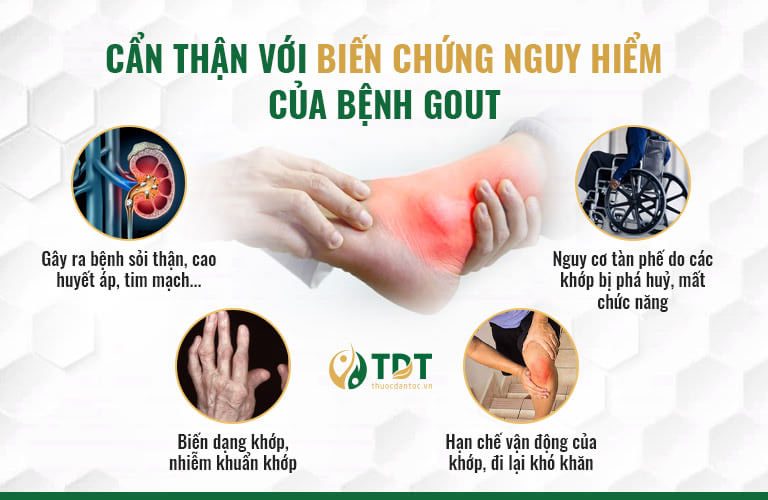 Biến chứng nguy hiểm của bệnh gout