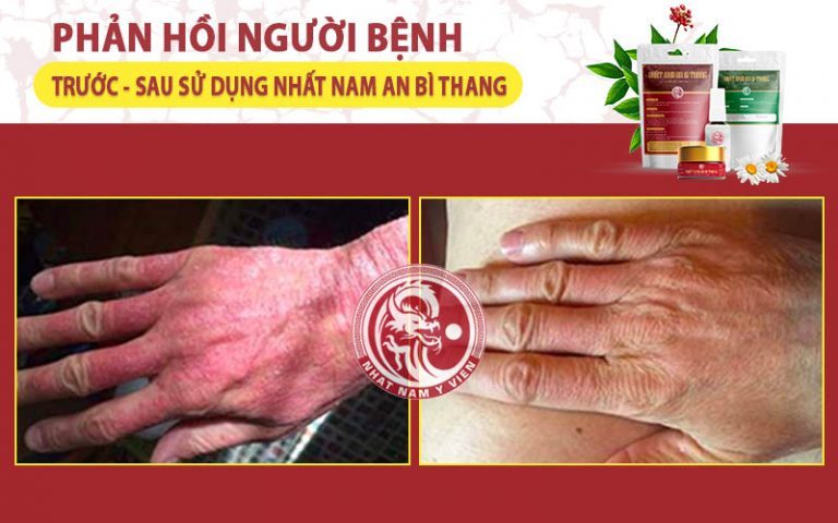 Người bệnh vảy nến hài lòng với sự cải thiện của làn da nhờ sử dụng Nhất Nam An Bì Thang (ảnh Trung tâm Da liễu Đông y Việt Nam cung cấp)