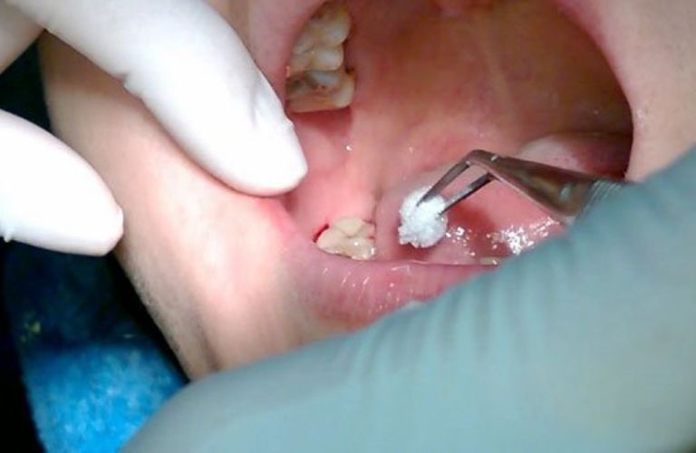 Răng khôn là gì? Biến chứng thường gặp khi mọc răng khôn?
