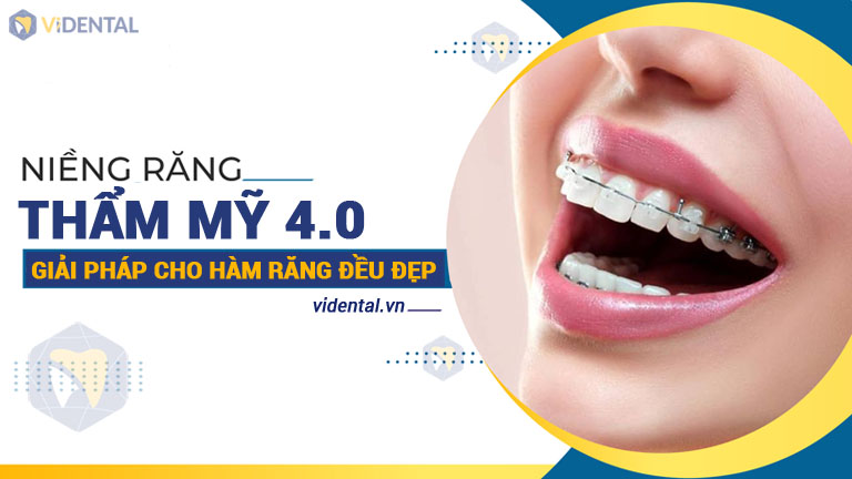 Niềng răng là phương pháp nha khoa thẩm mỹ phổ biến được nhiều người lựa chọn