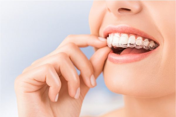 Niềng răng trong suốt invisalign mất bao lâu?